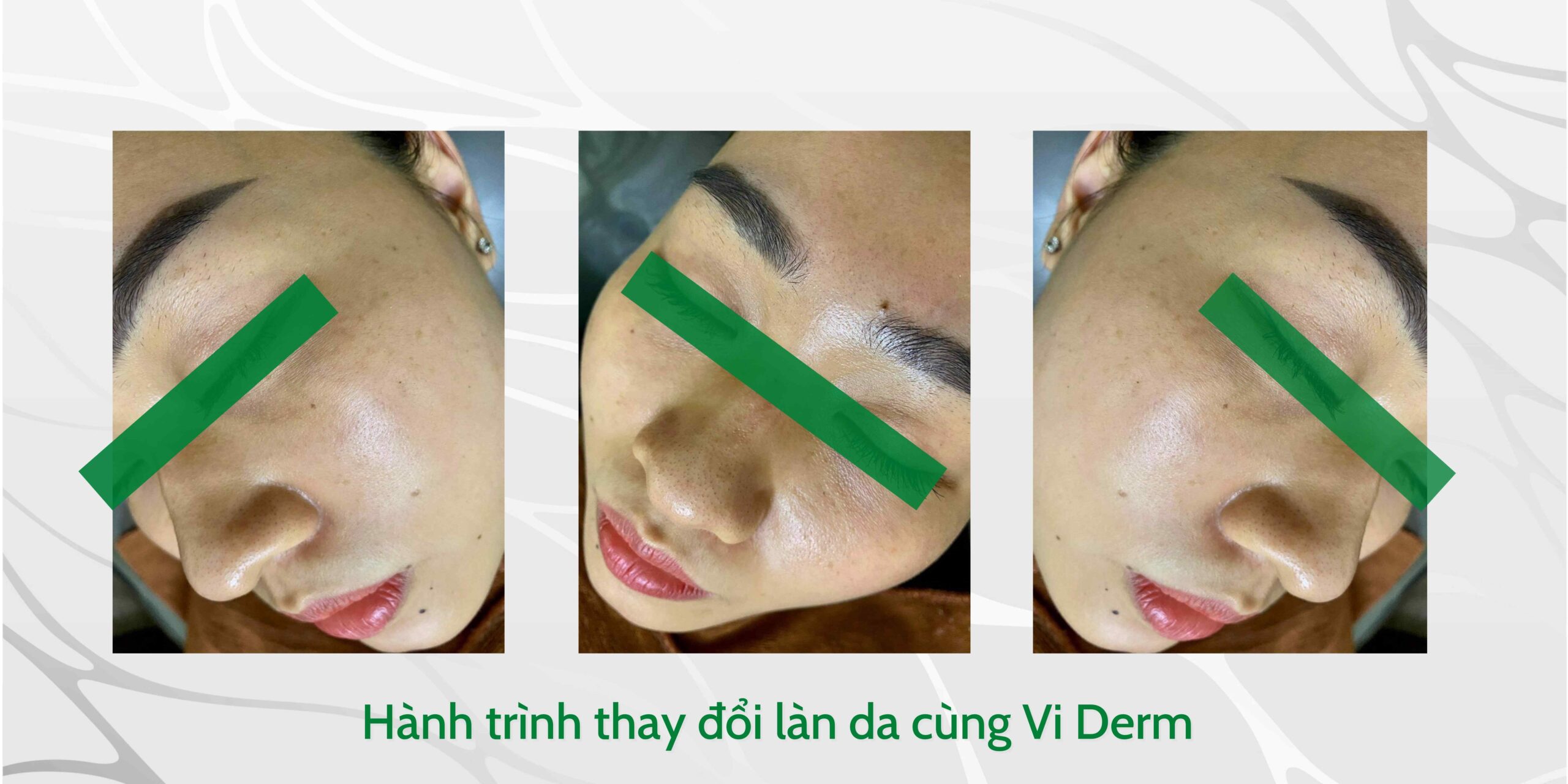 Hành trình thay đổi làn da sau 1 tháng sử dụng Bộ Sản Phẩm Loại Bỏ Sắc Tố VI Derm Beauty Pigment Correction System.
