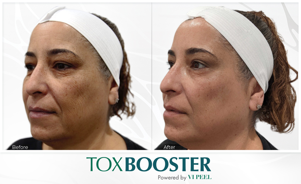 Khám Phá Phương Pháp ToxBooster - Kết hợp Giữa Botox Và VI Peel