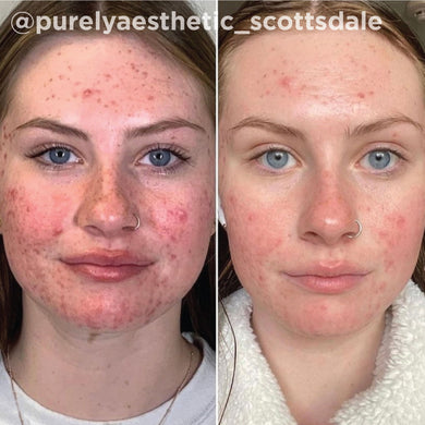 Hiệu quả VI Peel