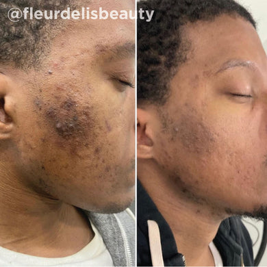 Hiệu quả VI Peel