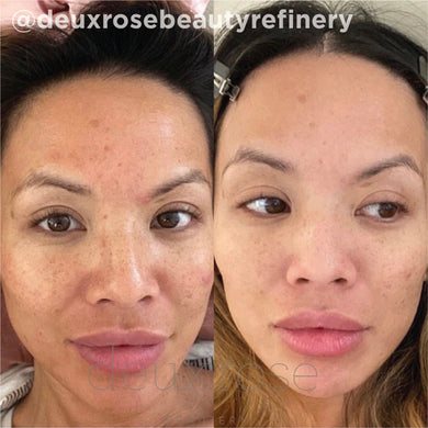 Hiệu quả VI Peel