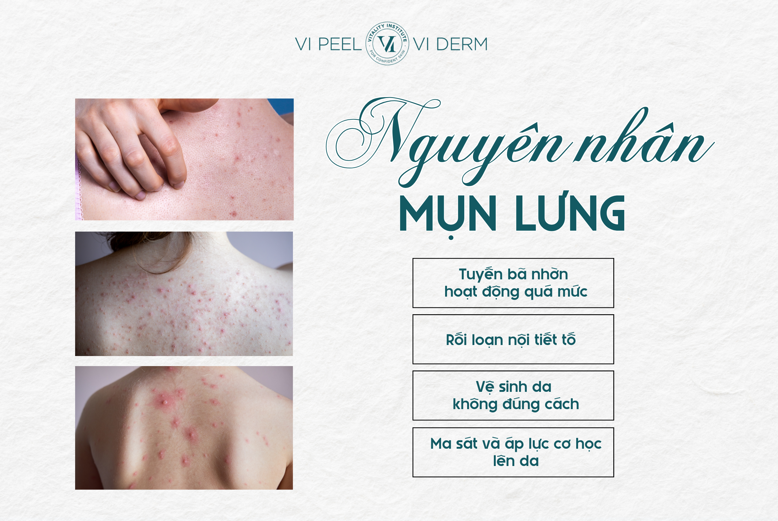Mụn lưng là một dạng mụn trứng cá hình thành do sự rối loạn trong cơ chế điều tiết bã nhờn và sừng hóa lỗ chân lông