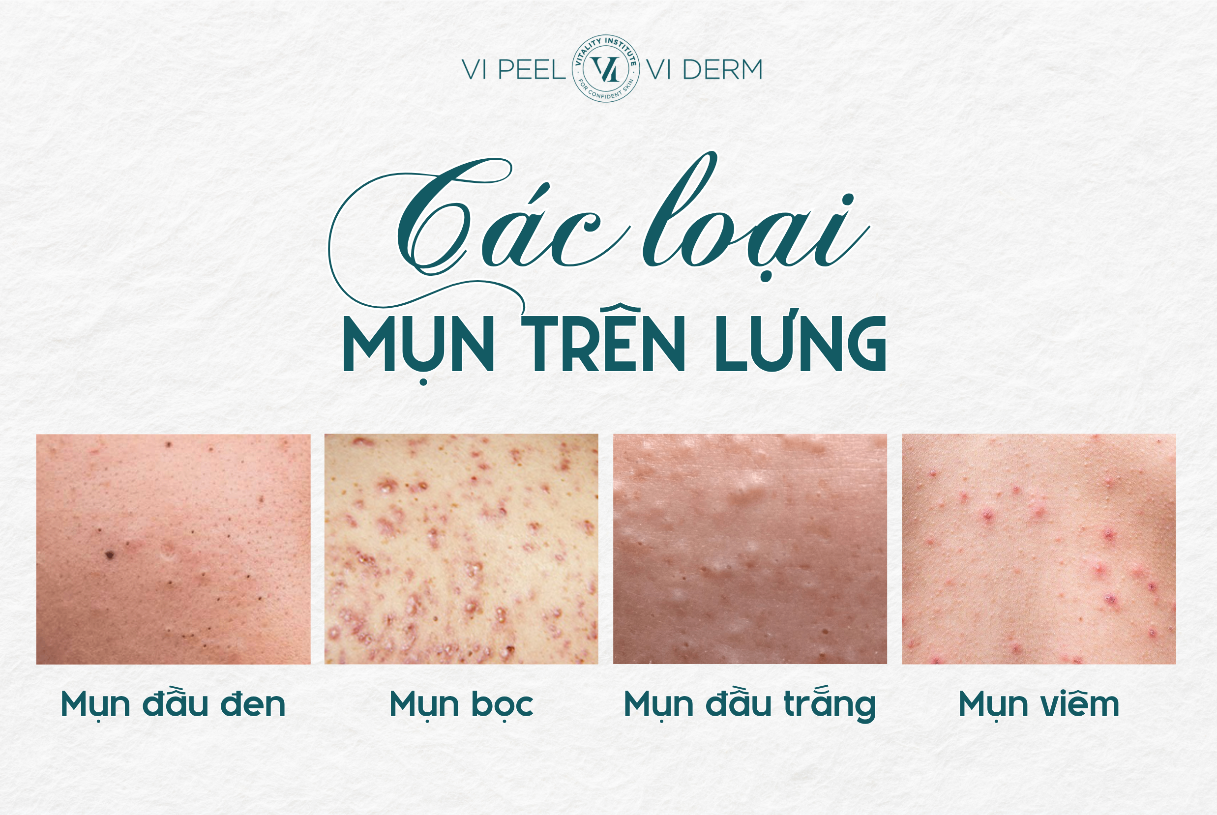 Mụn trên lưng không phải là một dạng mụn đơn lẻ mà bao gồm nhiều loại tổn thương da liễu khác nhau