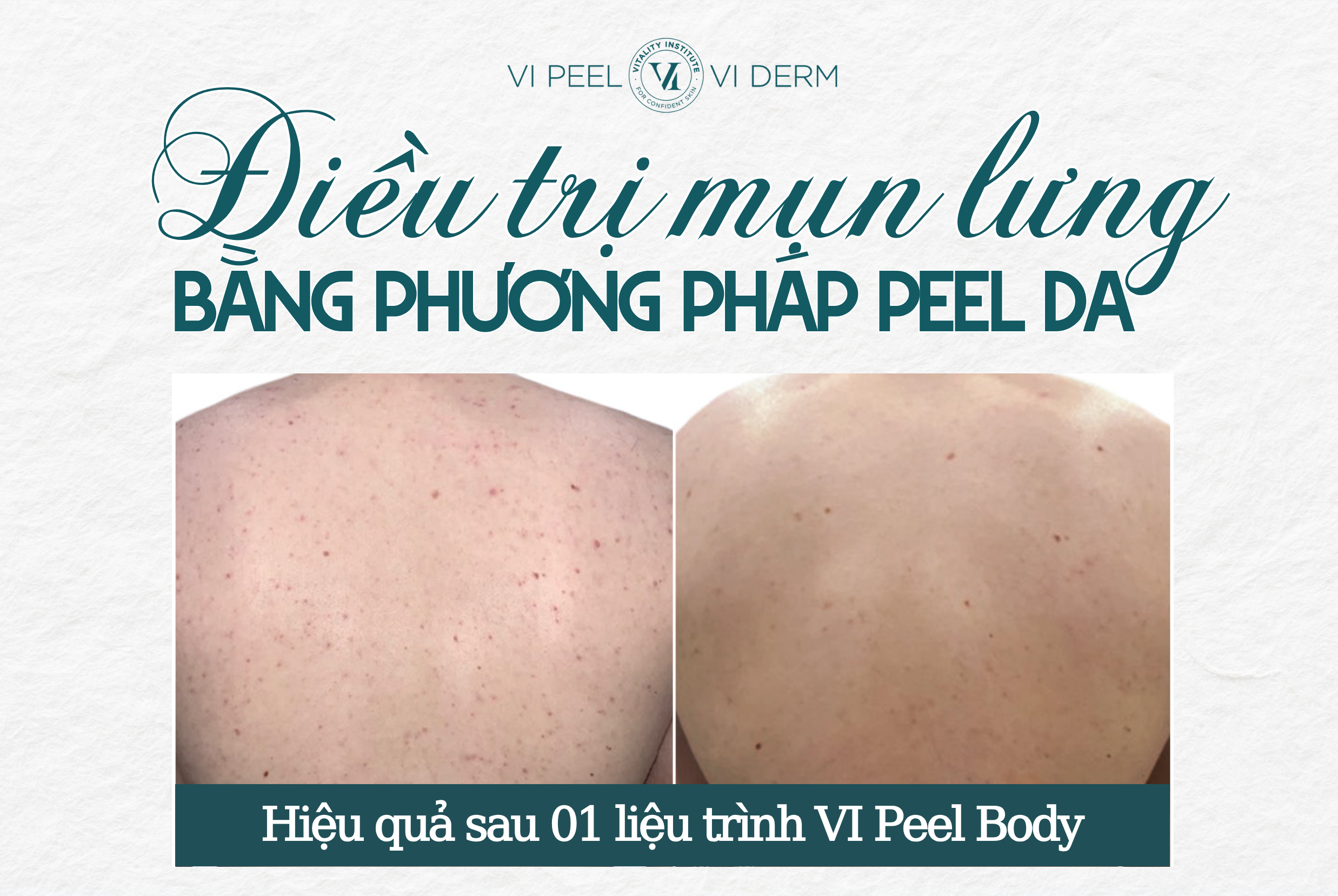 Peel da là kỹ thuật sử dụng các acid chuyên biệt như AHA, BHA hoặc TCA