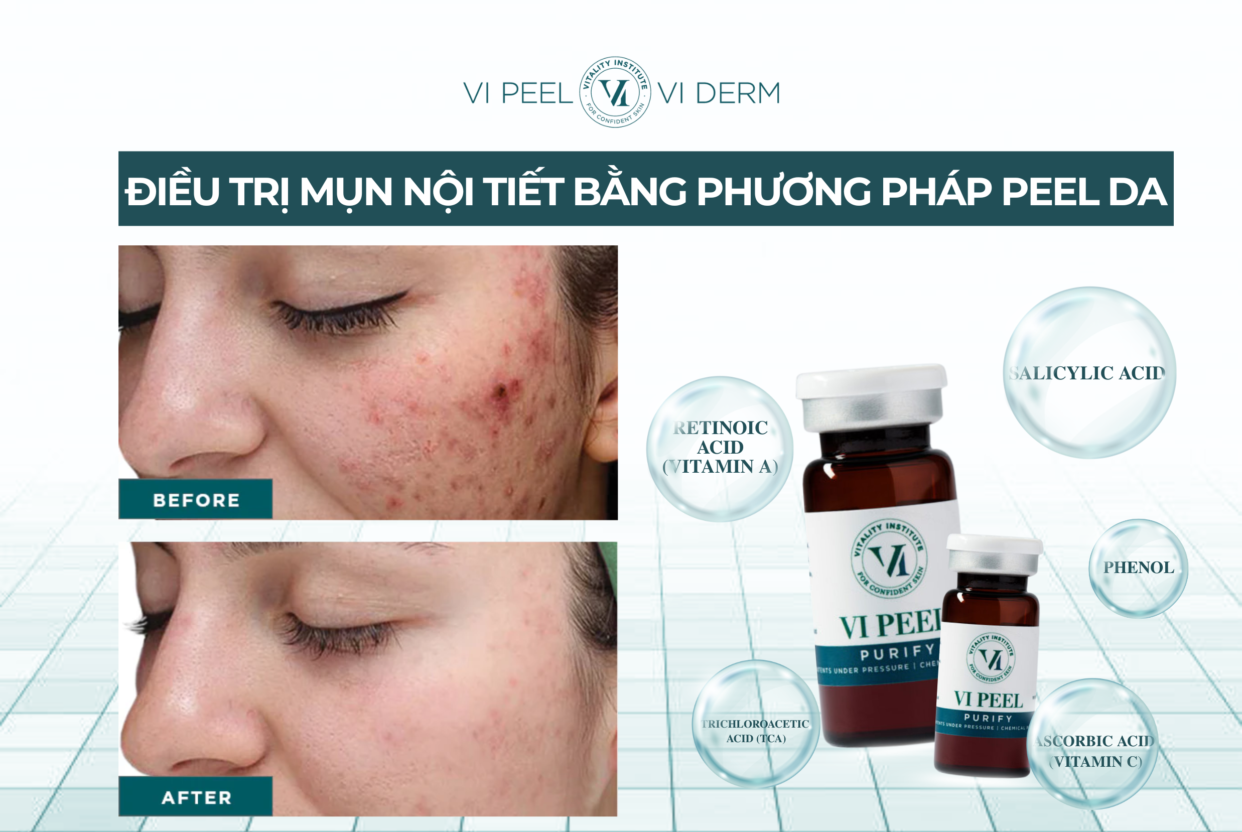 Peel da giúp giảm tình trạng bít tắc, nguyên nhân trực tiếp gây hình thành mụn viêm
