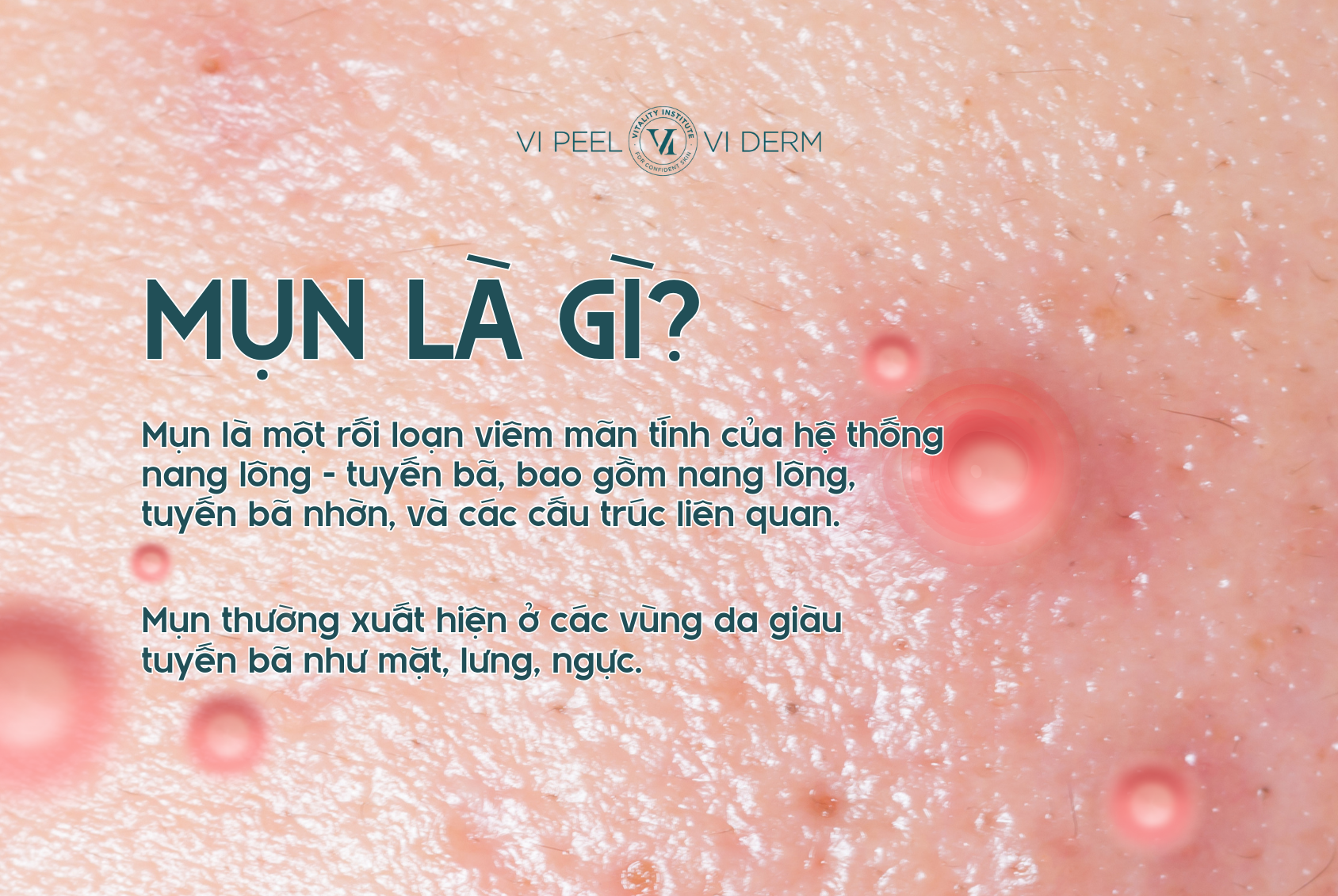 Mụn là một rối loạn viêm mãn tính của hệ thống nang lông - tuyến bã