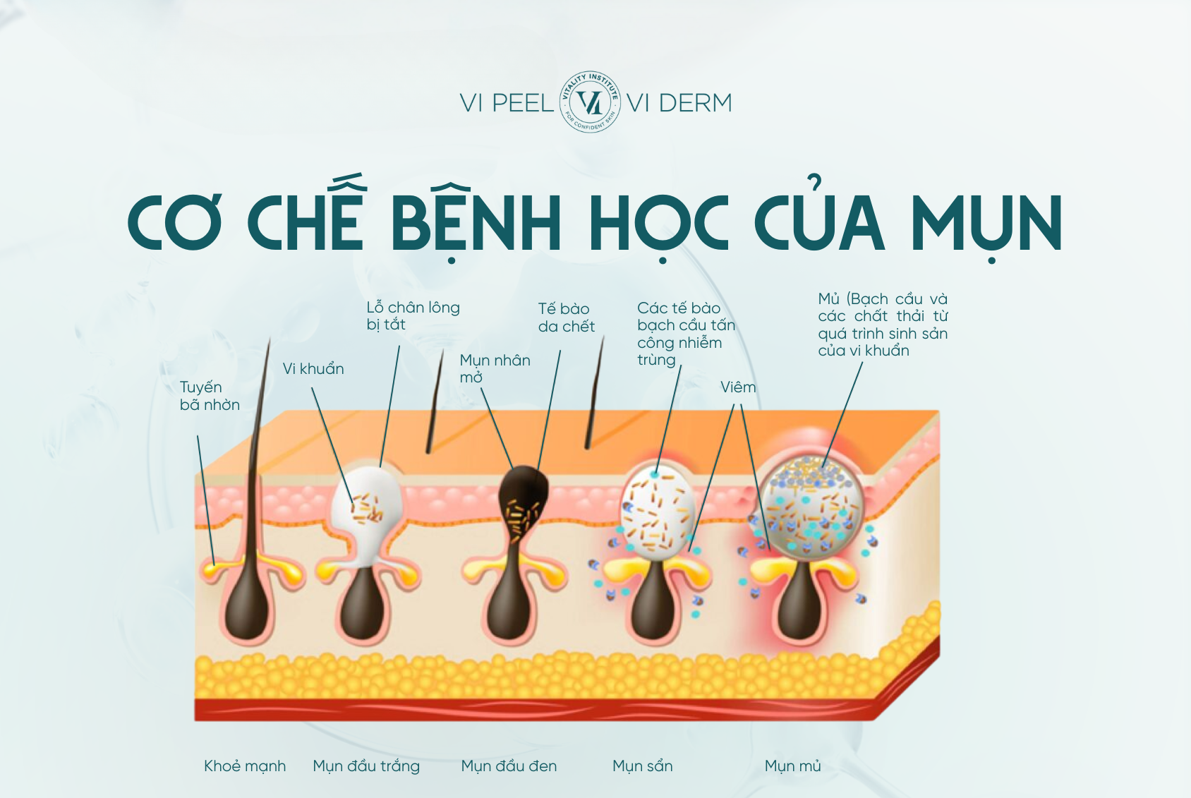 Sự phát triển của mụn trứng cá là kết quả của một chuỗi các sự kiện sinh lý bệnh liên kết chặt chẽ