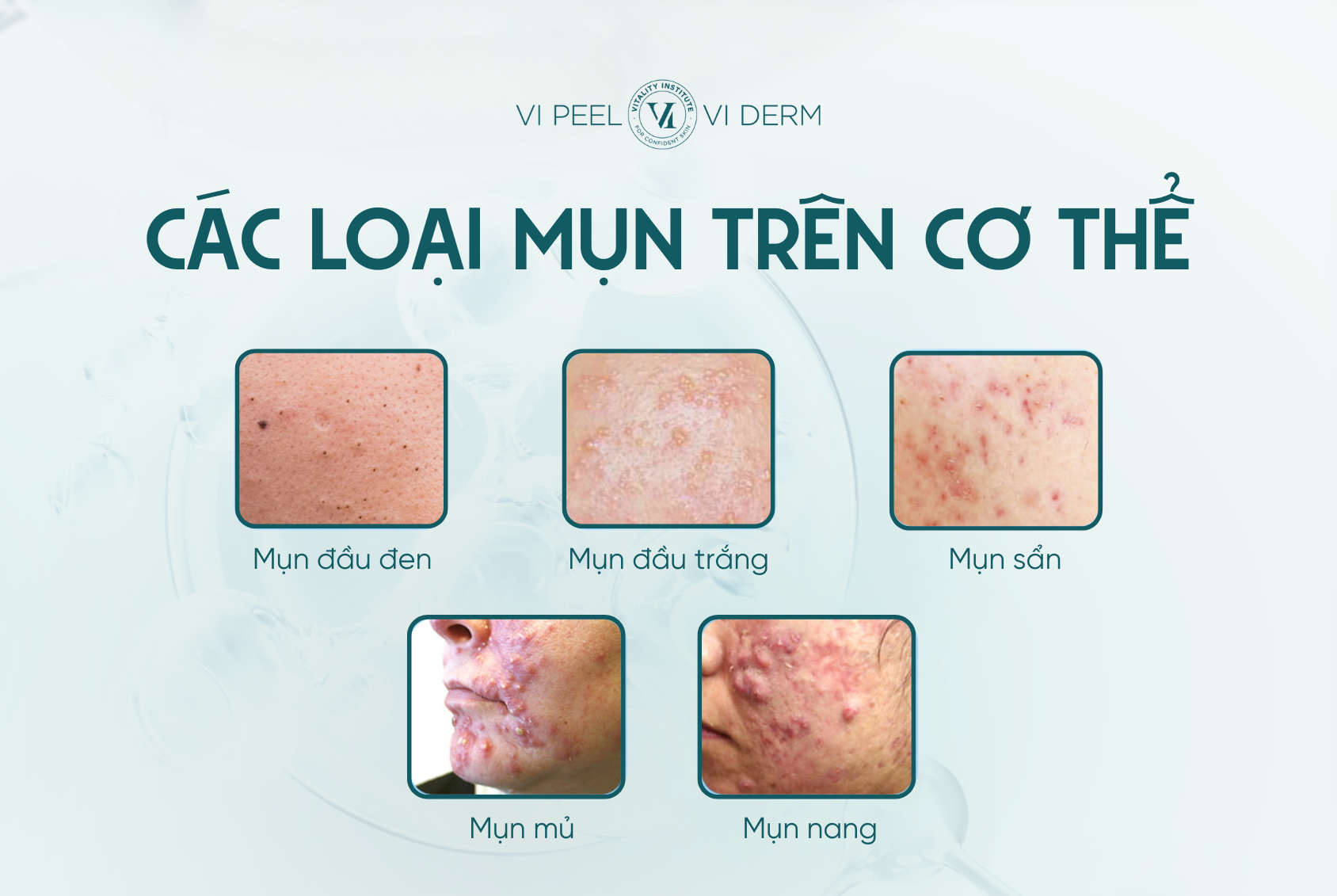 Các loại mụn phổ biến trên cơ thể