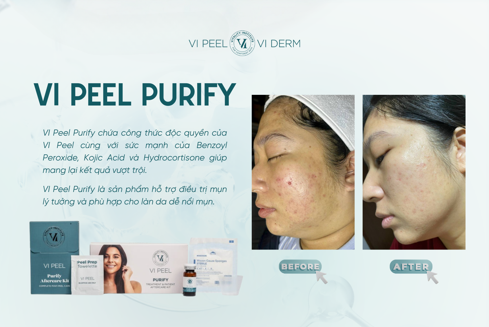 Peel da hóa học là phương pháp sử dụng acid nồng độ kiểm soát để loại bỏ lớp sừng chết trên bề mặt da