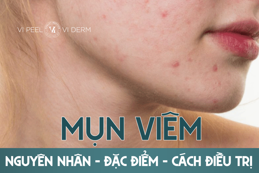 Mụn viêm là gì? Nguyên nhân, đặc điểm và cách điều trị