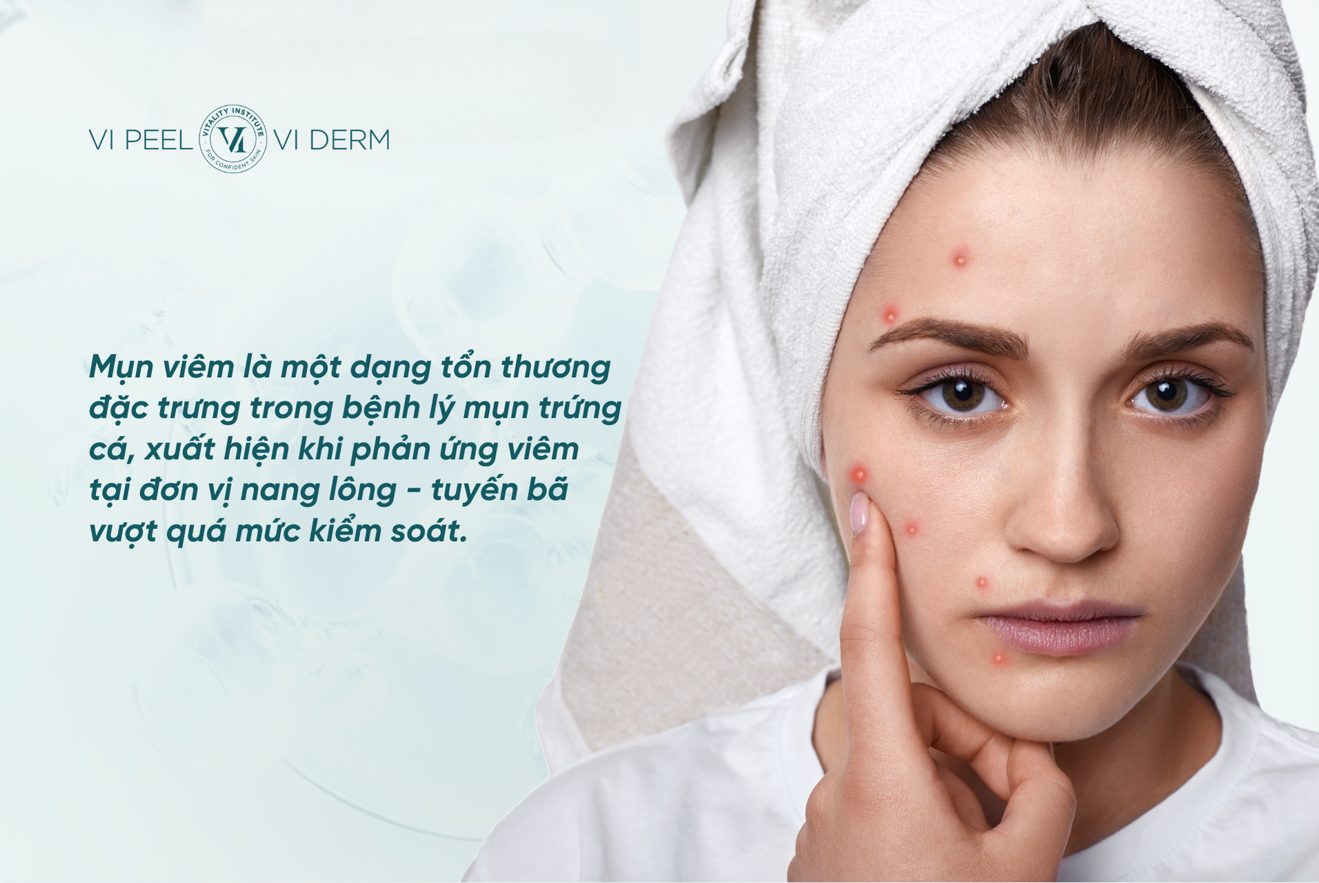Mụn viêm xuất hiện khi phản ứng viêm tại đơn vị nang lông - tuyến bã vượt quá mức kiểm soát sinh lý bình thường
