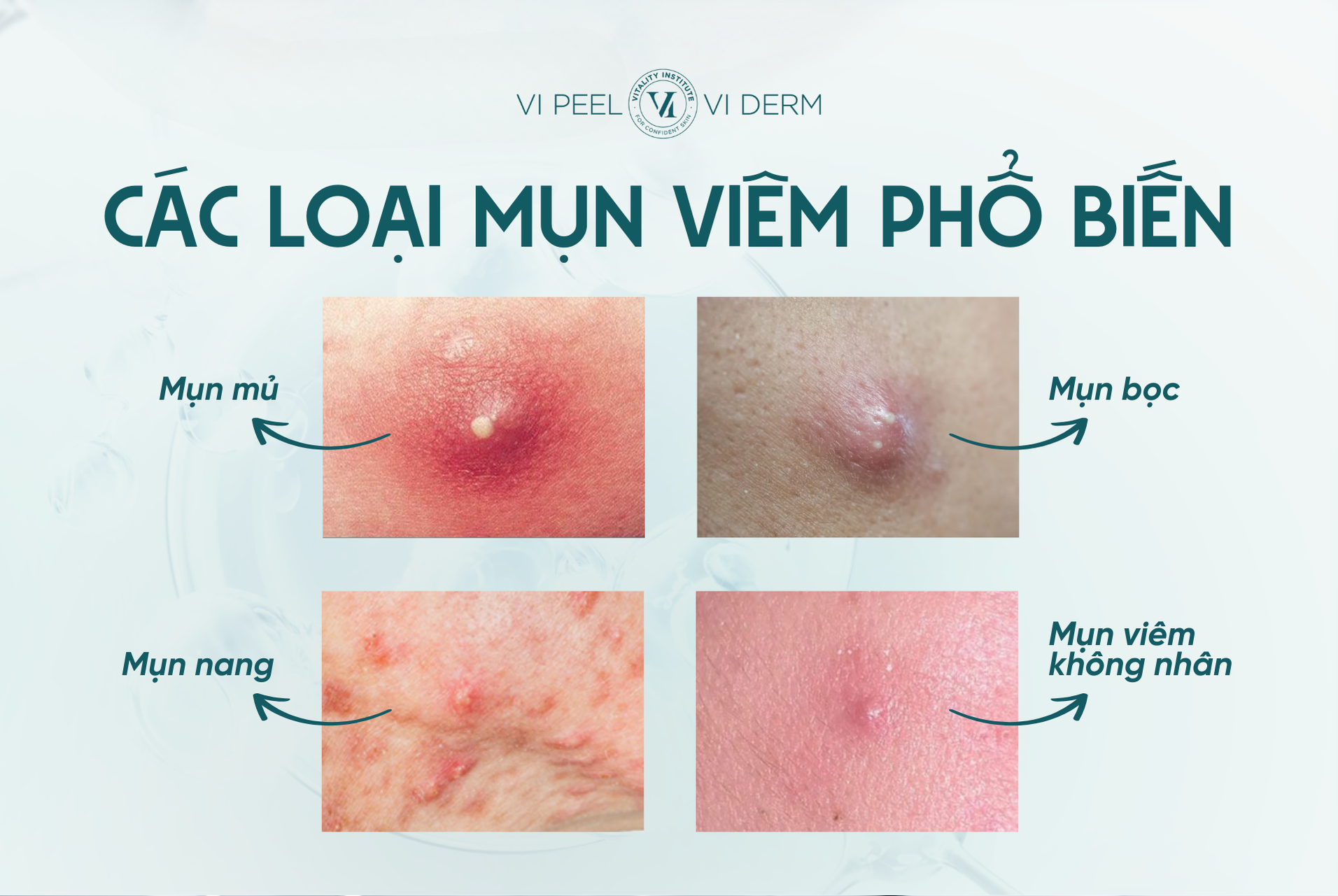 Các loại mụn viêm thường gặp 