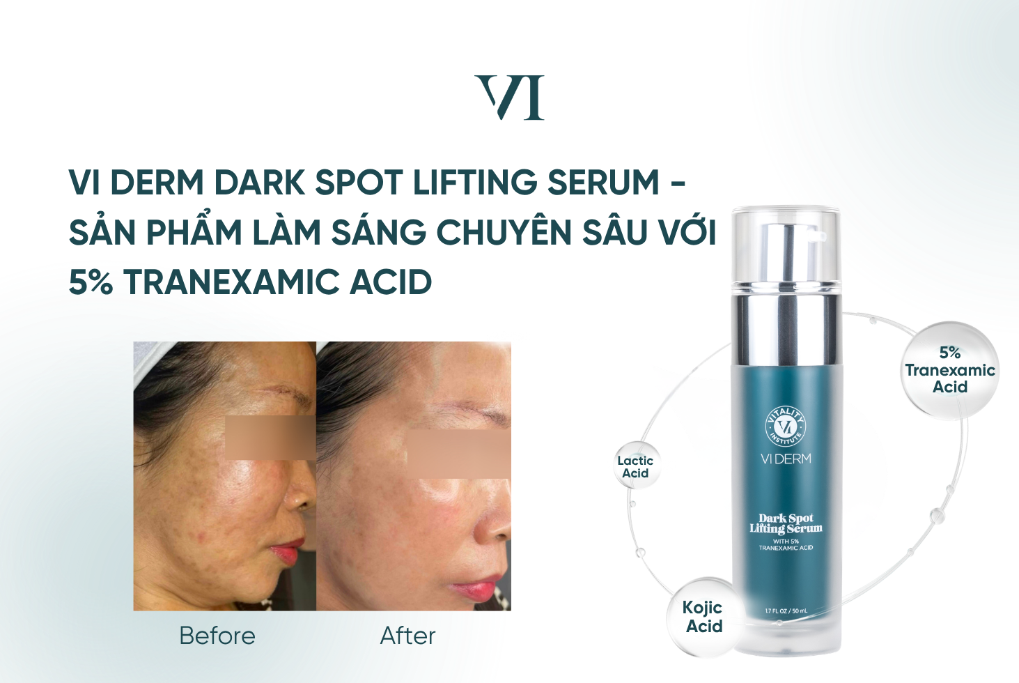 VI Derm Dark Spot Lifting Serum là serum chuyên biệt cho vấn đề sắc tố, nổi bật với 5% Tranexamic Acid